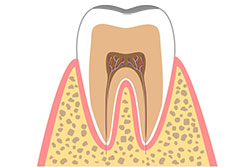 1.初期の虫歯