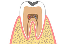 2.エナメル質の虫歯