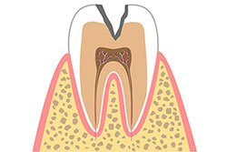 3.象牙質の虫歯