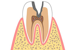 4.神経まで達した虫歯