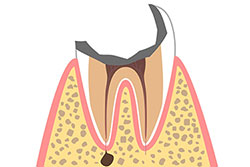 5.歯の根だけが残る虫歯