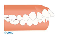 上顎前突(出っ歯)