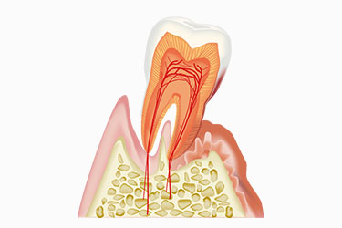 歯周病ってどんな病気？