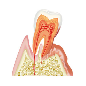歯周病治療